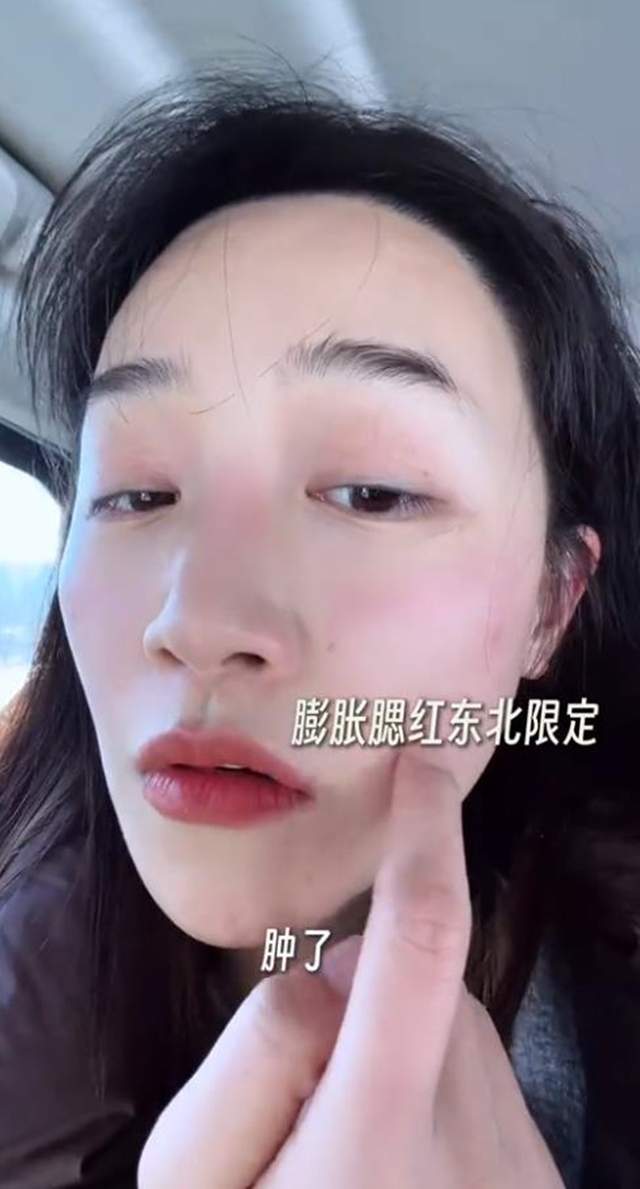 原創(chuàng)藍(lán)盈瑩吉林游玩，零下24度戶外只待半個(gè)小時(shí)就被凍傷，臉又紅又腫