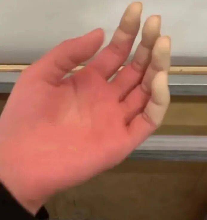 四川女大學(xué)生東北雪地里摔暈后，3根手指或面臨截肢