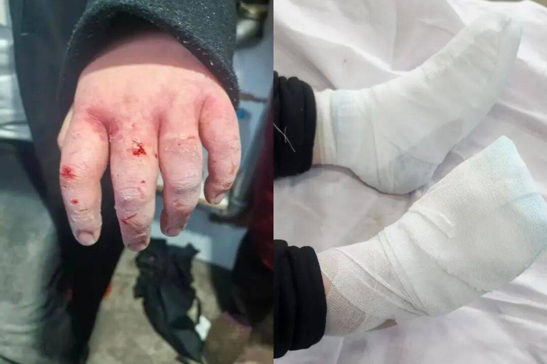 女大學(xué)生東北雪地里摔暈后，3根手指或面臨截肢