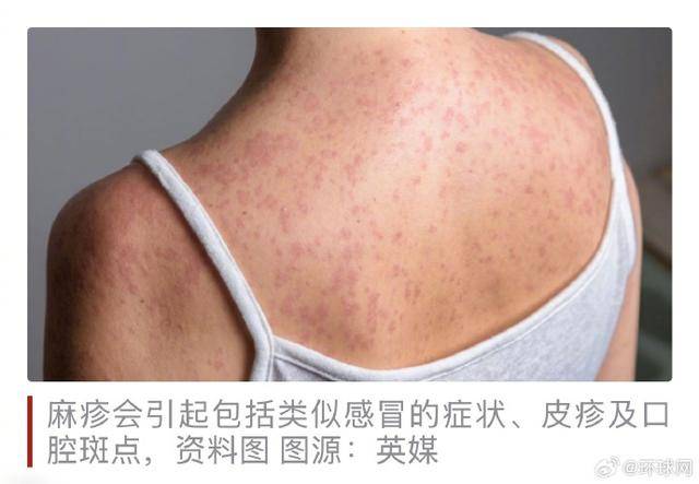 倫敦多所學(xué)校暴發(fā)“快速傳播”麻疹疫情，數(shù)十人感染